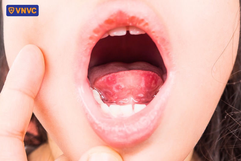tay chân miệng gây lỡ loét ở vùng miệng của trẻ