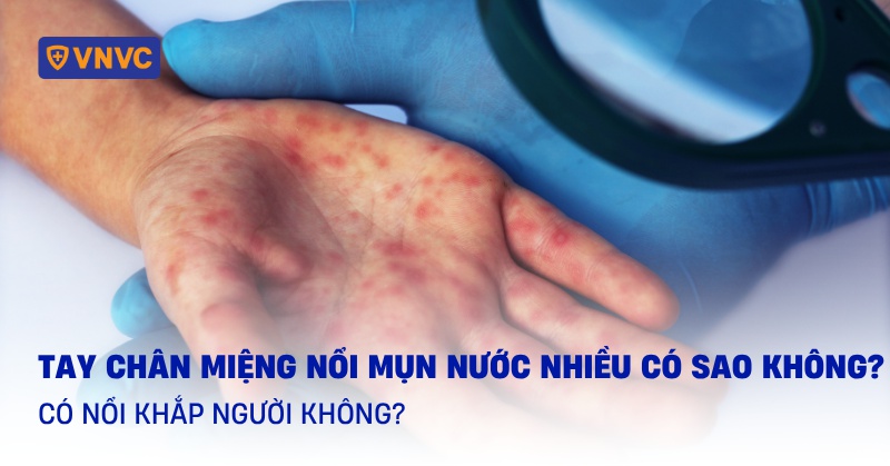 Tay chân miệng nổi mụn nước nhiều có sao không? Có nổi khắp người không?