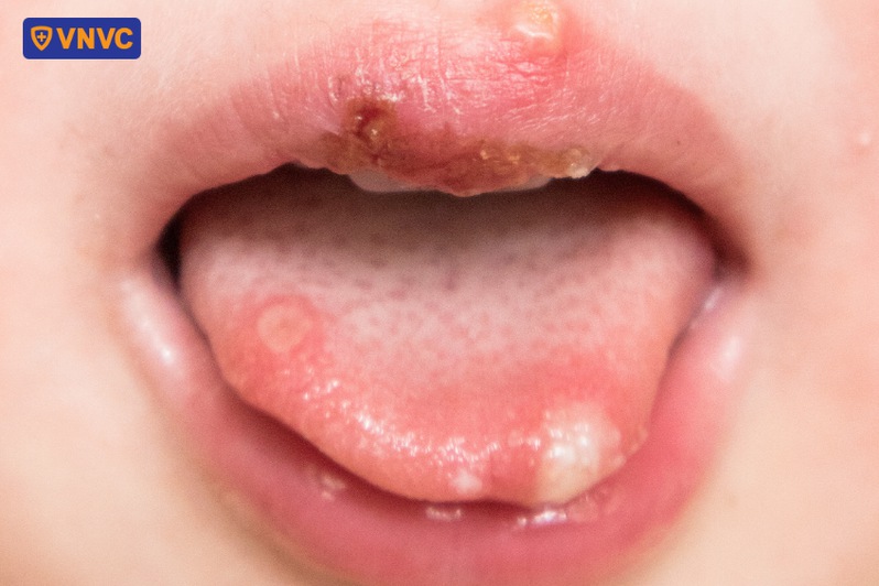 trái cây có acid cao gây kích ứng