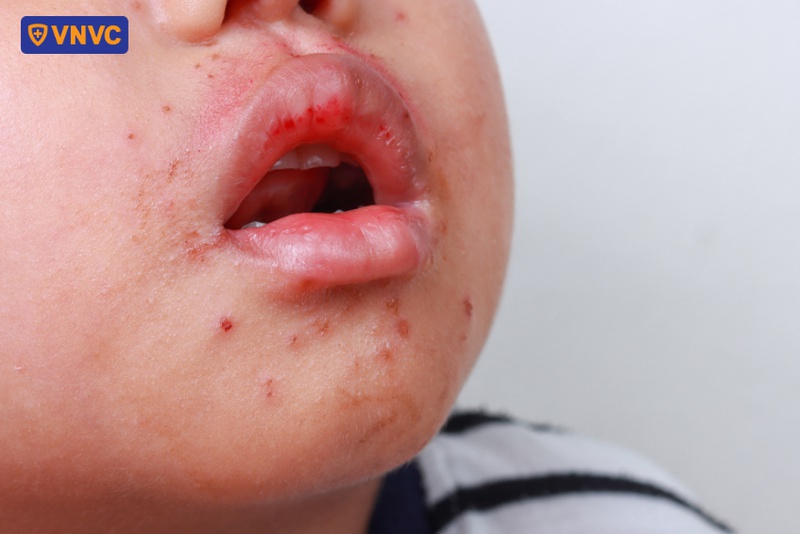 trẻ bị tay chân miệng có để lại sẹo không