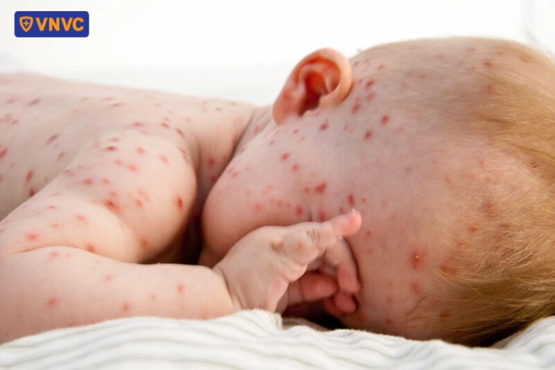 bé sơ sinh bị thủy đậu