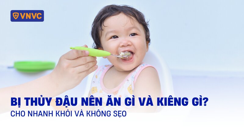 bị thủy đậu kiêng ăn gì