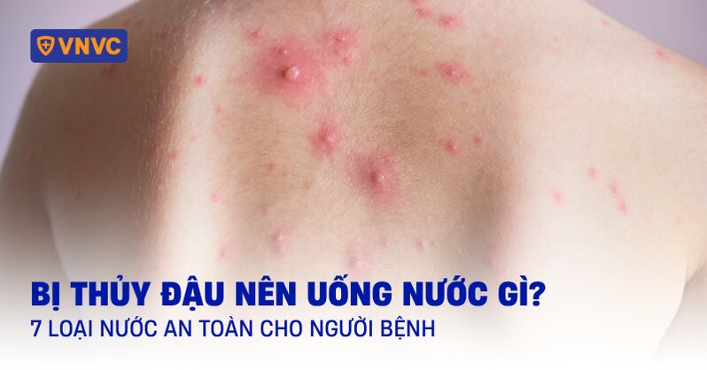 bị thủy đậu nên uống nước gì
