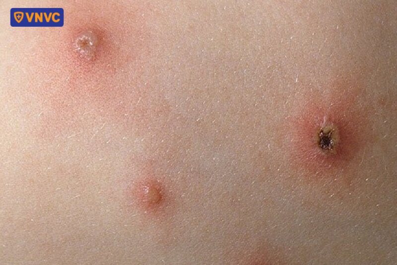 các nốt mụn thủy đậu