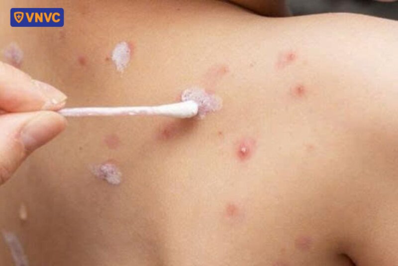 chăm sóc mụn nước thủy đậu