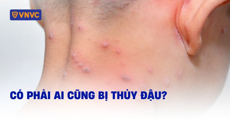 có phải ai cũng bị thủy đậu