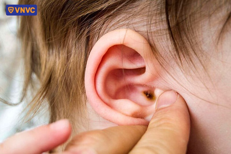 mắc viêm tai giữa do phế cầu