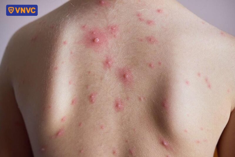mụn nước thủy đậu nổi trên lưng