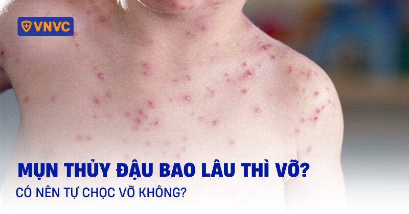 mụn thủy đậu bao lâu thì vỡ