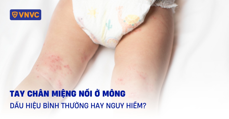 Tay chân miệng nổi ở mông: Dấu hiệu bình thường hay nguy hiểm?