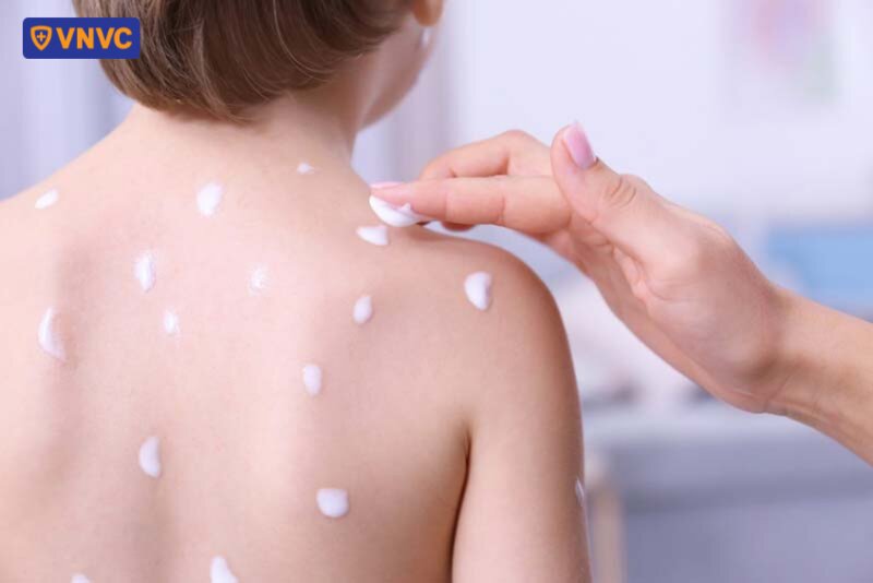 thoa kem cho bé bị thủy đậu