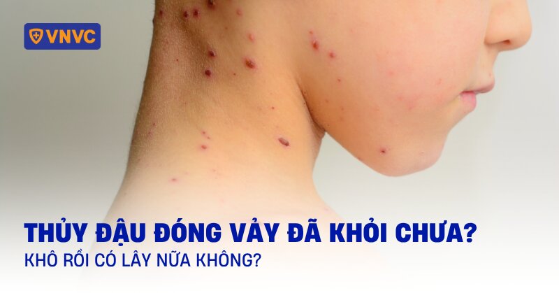 thủy đậu đóng vảy đã khỏi chưa