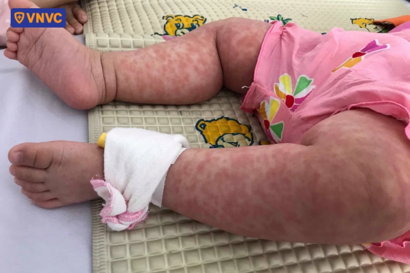 trẻ mắc bệnh nặng do không tiêm vắc xin phòng ngừa
