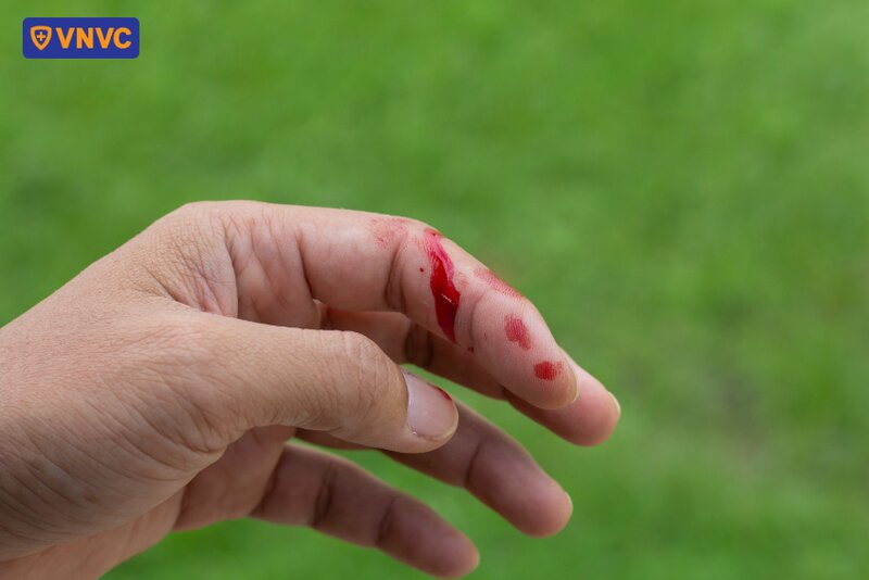 vết thương do chó dại cắn có chứa virus dại