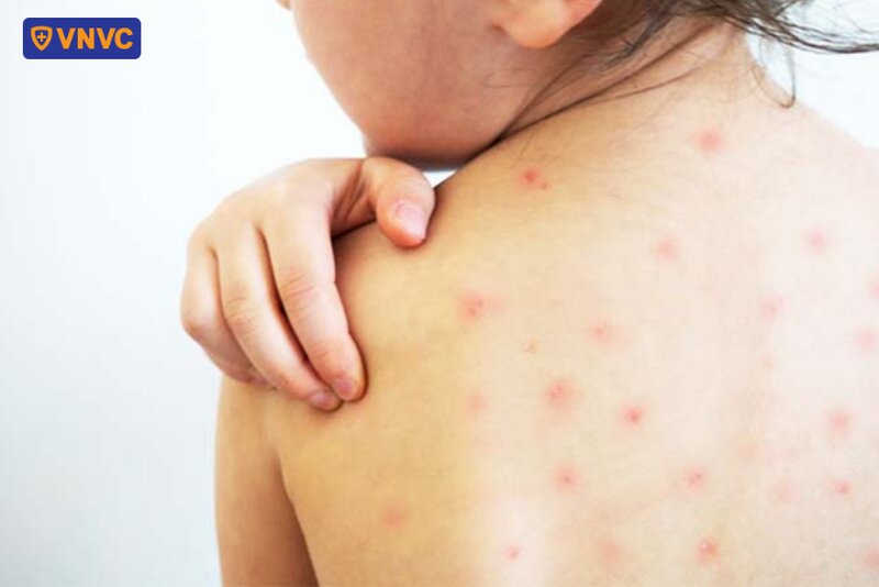 bé gãi mụn thủy đậu