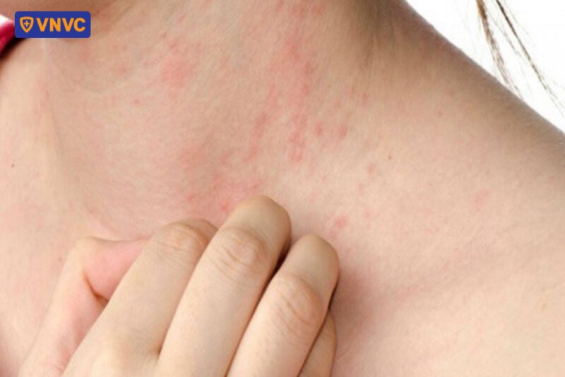 bị rôm sảy