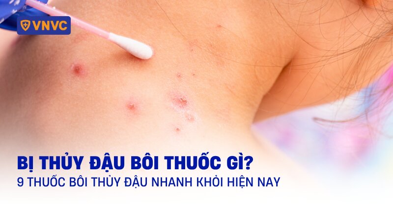 bị thủy đậu bôi thuốc gì