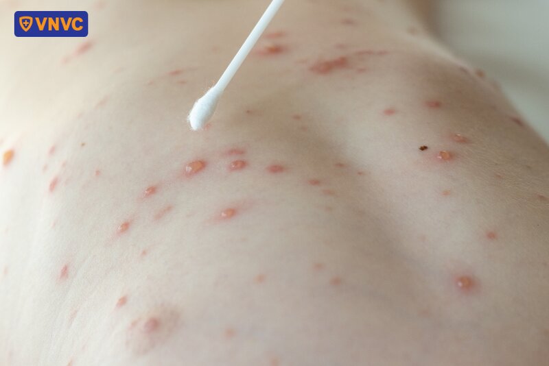 bôi thuốc lên mụn nước thủy đậu