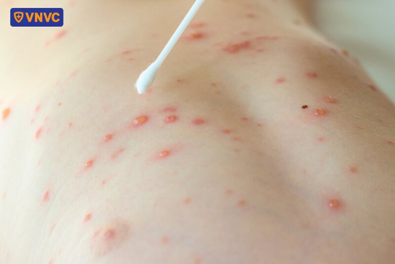bôi thuốc thủy đậu lên vùng da tổn thương