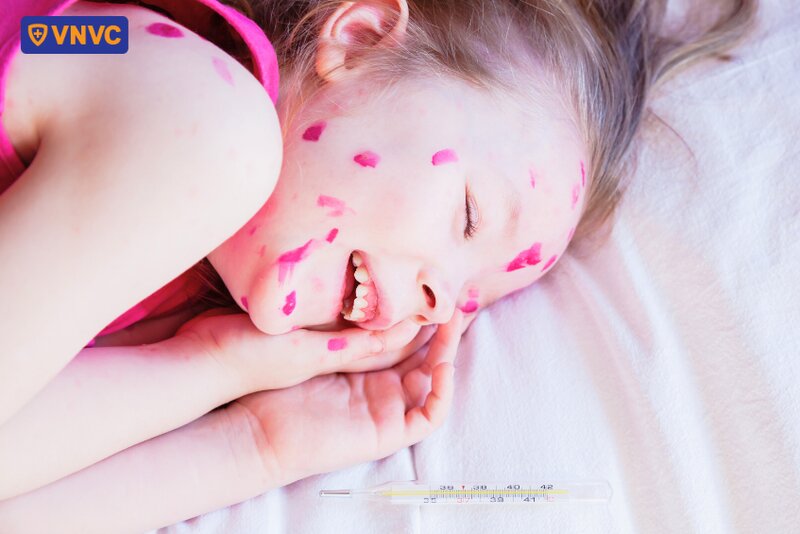 bôi thuốc tím cho trẻ bị thủy đậu