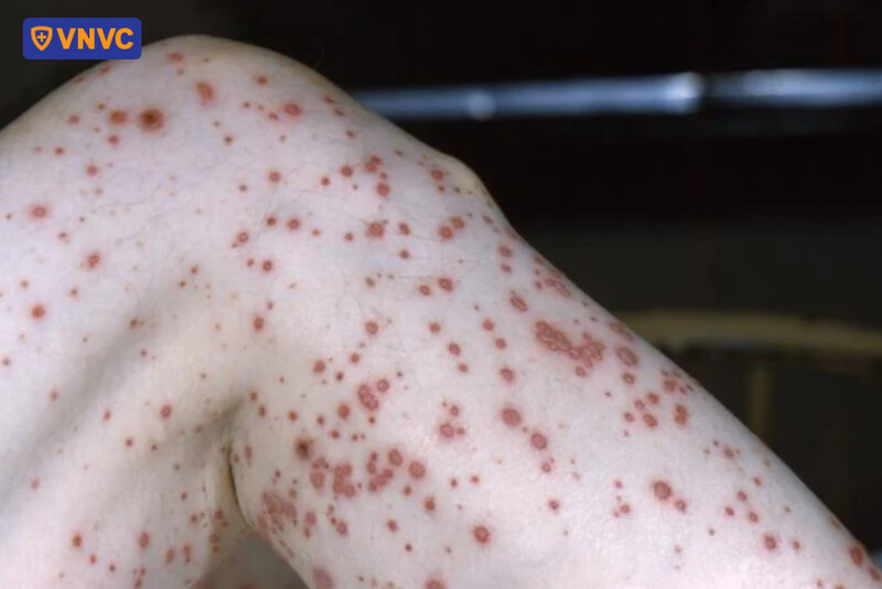 có dịch trong nốt mụn