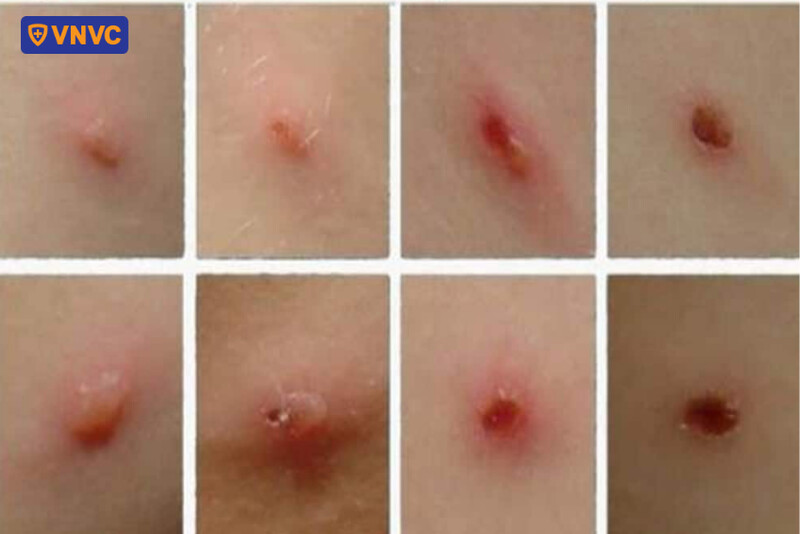 có vết sẹo rỗ