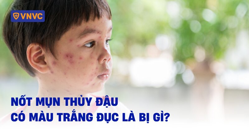 mụn thủy đậu có màu trắng đục