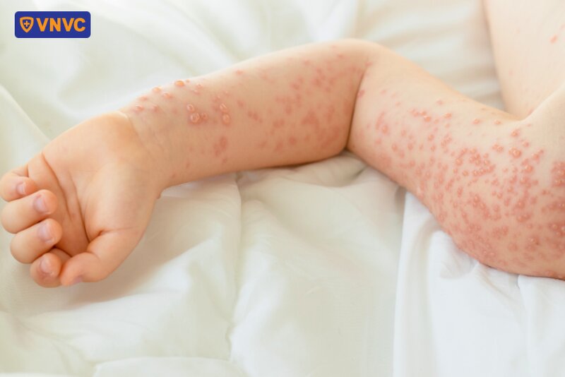 mụn thủy đậu nổi đầy trên tay bé