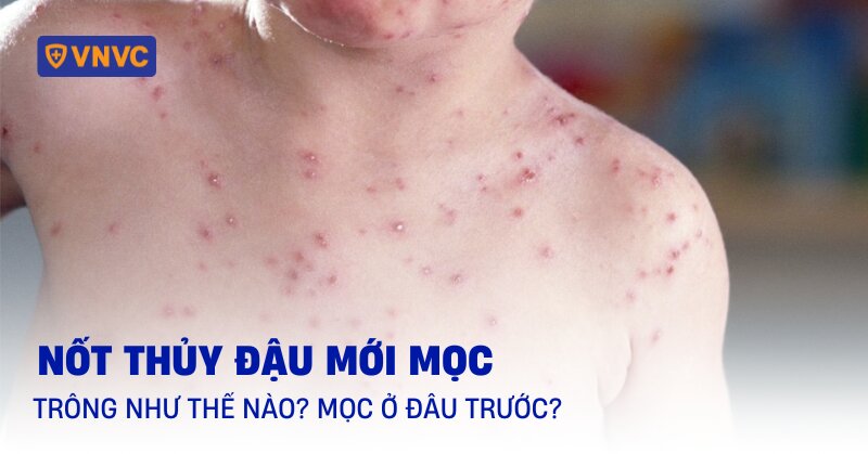 nốt thủy đậu mới mọc