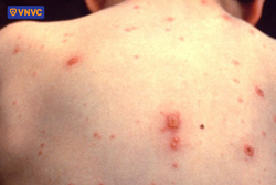 nốt htủy đậu trên lưng