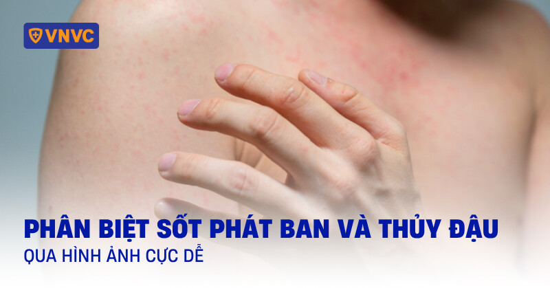 phân biệt sốt phát ban và thủy đậu