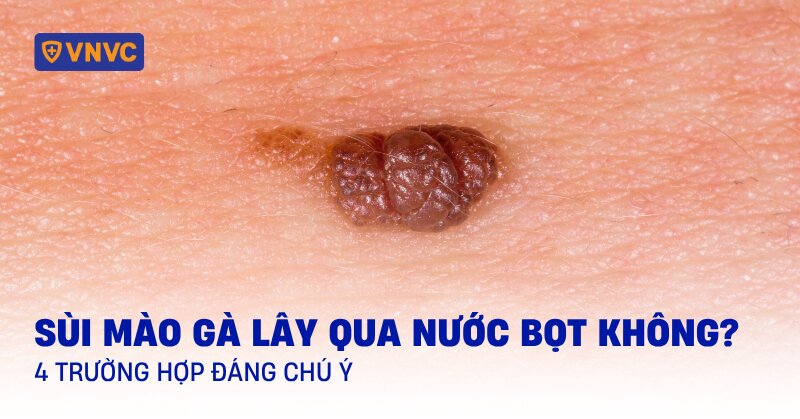 sùi mào gà lây qua nước bọt không