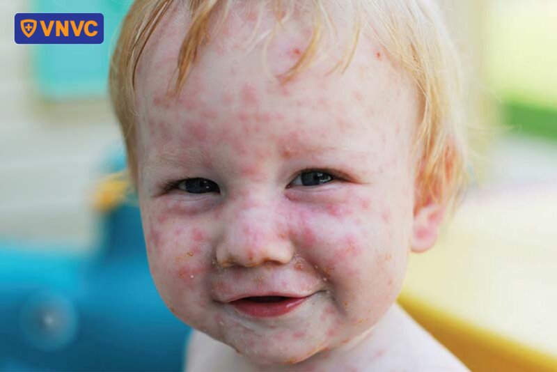 thủy đậu nổi trên mặt bé