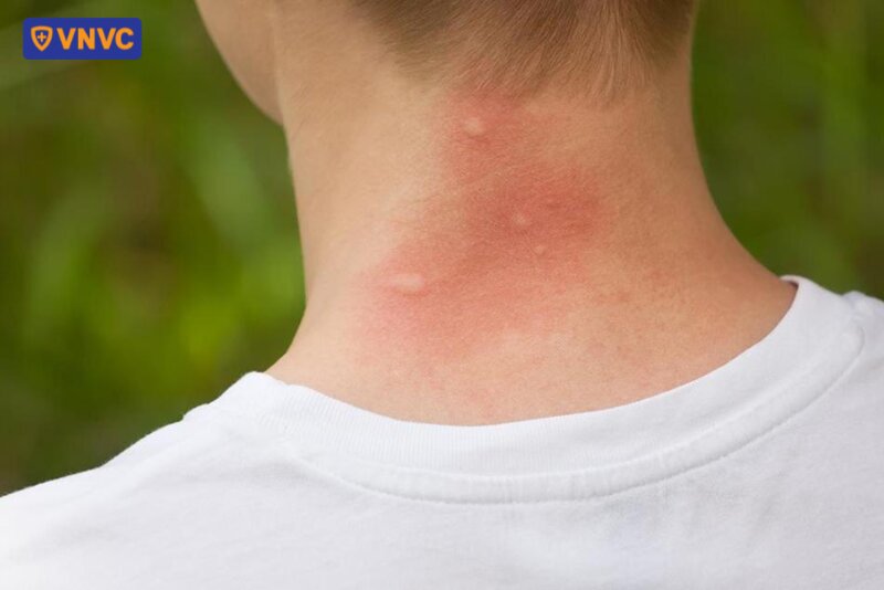 vết muỗi đốt trên cổ
