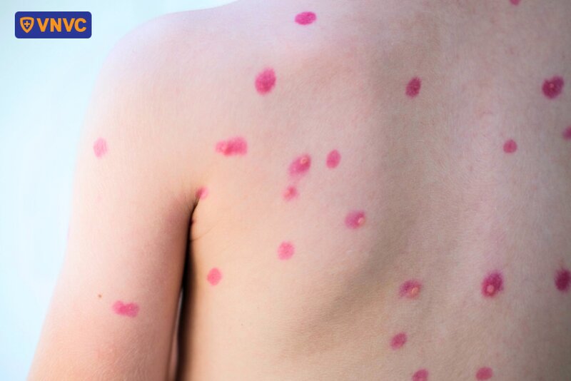 chấm thuốc thủy đậu trên lưng