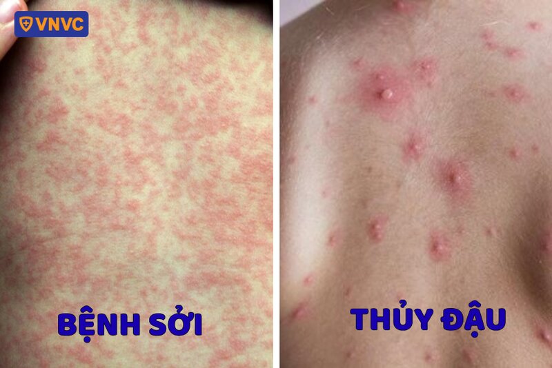 phân biệt sởi và thủy đậu