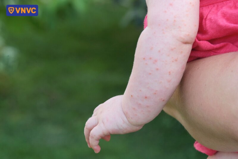 thủy đậu mọc trên tay bé