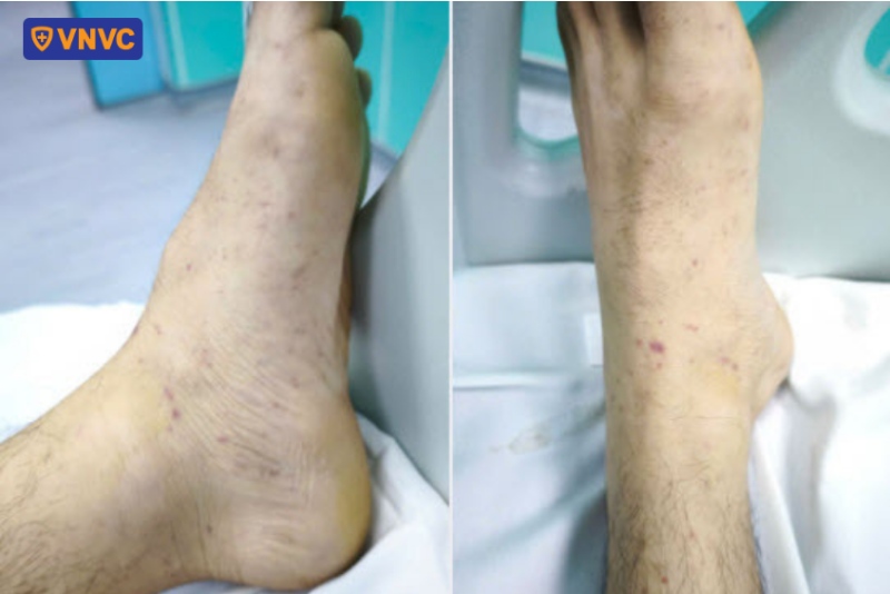 bệnh nhân cắt cụt tay cụt chân