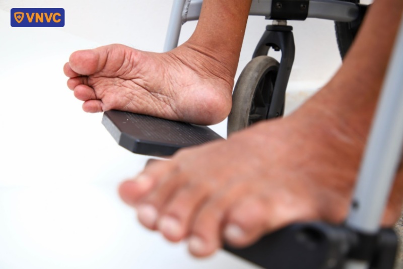 chân của người bại liệt