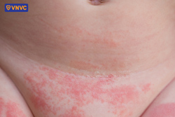 hình ảnh da bị phát ban