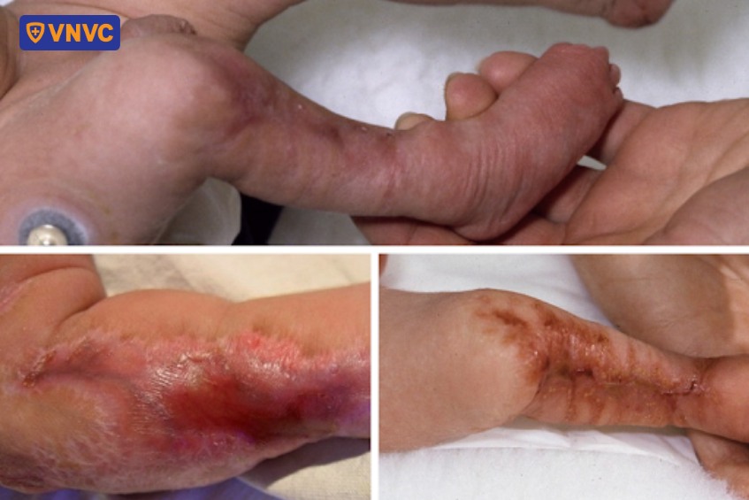 hội chứng thủy đậu bẩm sinh là rối loạn hiếm khi xảy ra