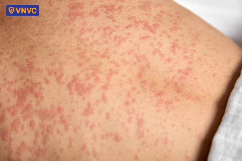 sởi có tốc độ lây lan nhanh