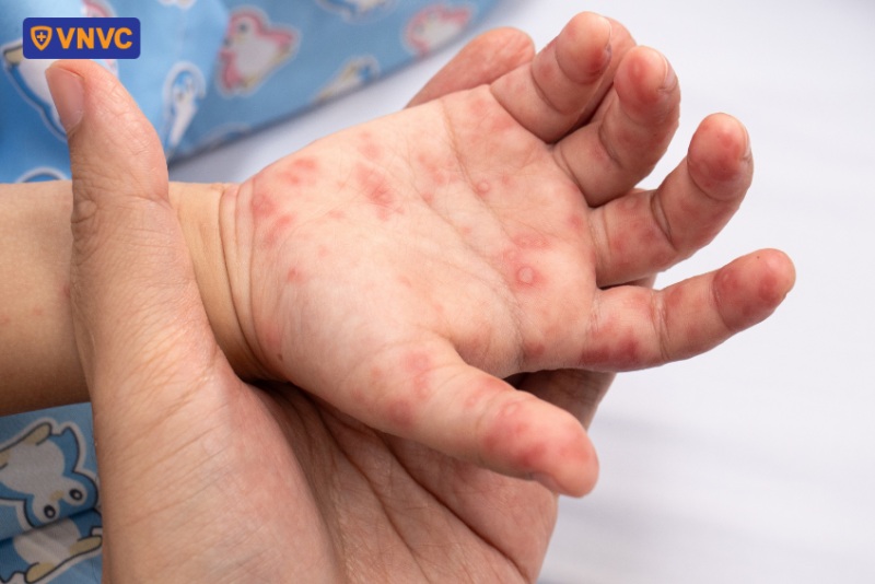 triệu chứng bệnh ở tay trẻ sơ sinh