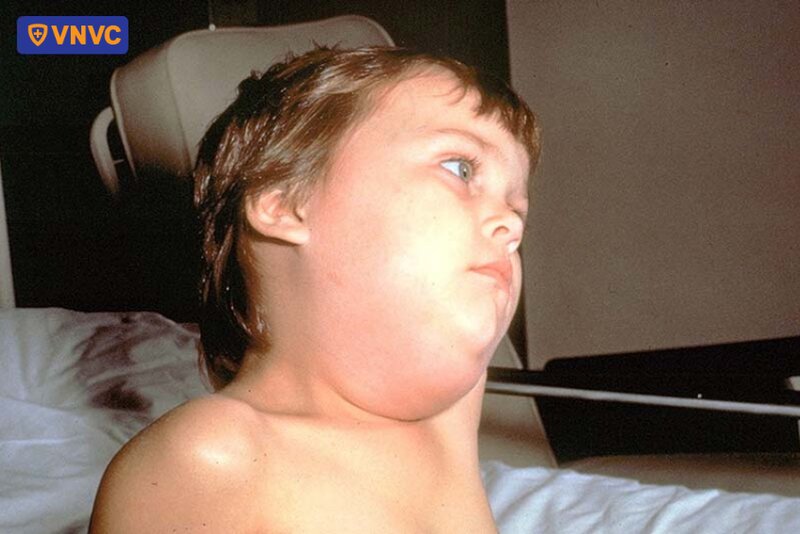 vùng quai hàm bị sưng phù