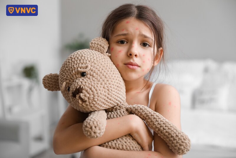 bé gái bị nổi thủy đậu khắp người