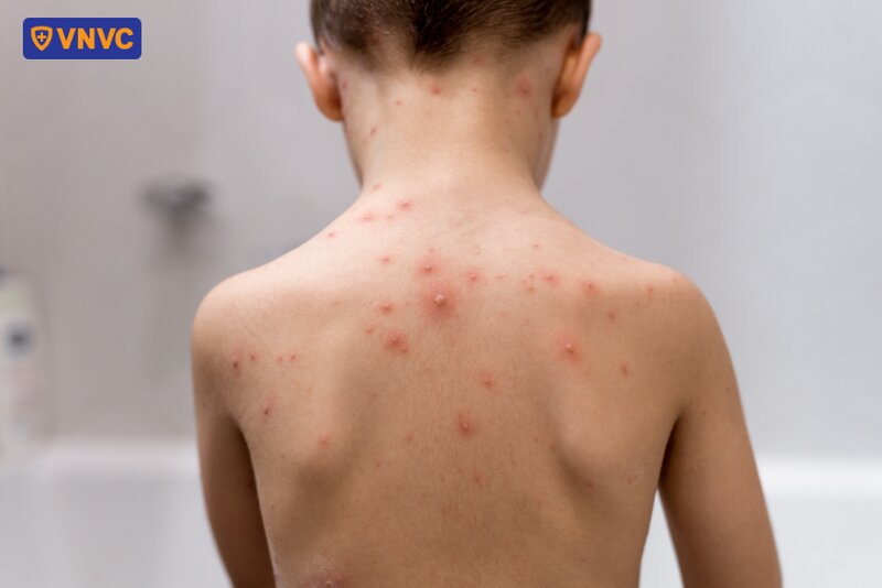 bệnh nhân nổi nốt thủy đậu