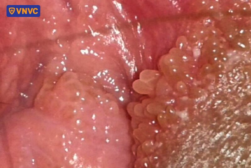 gai sinh dục mọc đều