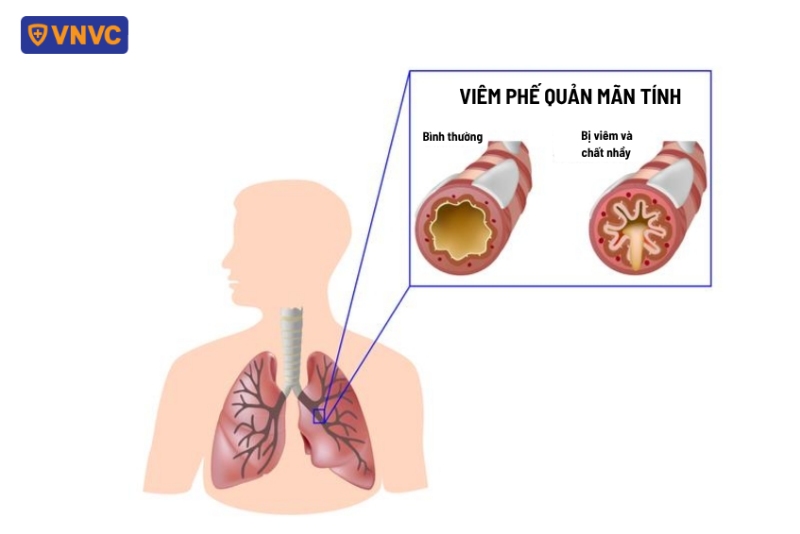 giải phẫu viêm phế quản mãn tính