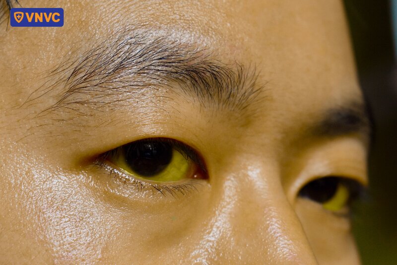 hình ảnh vàng mắt nghi ngờ viêm gan