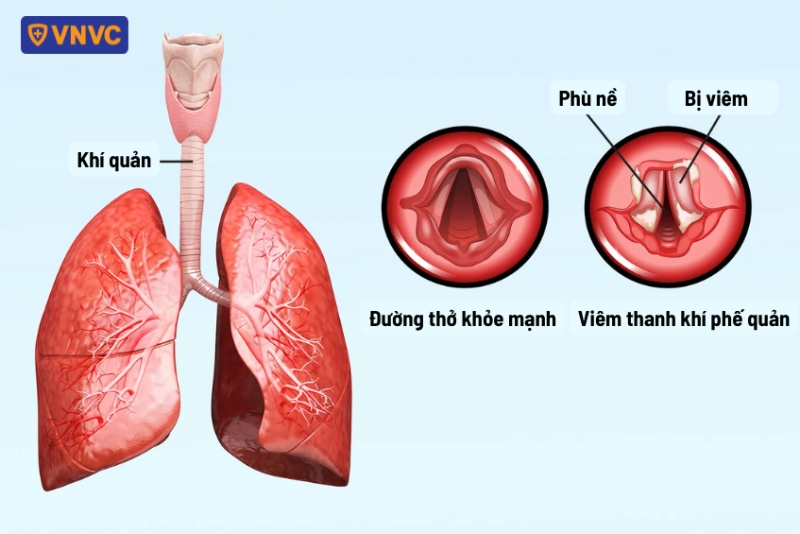 hình giải phẫu thanh khí phế quản